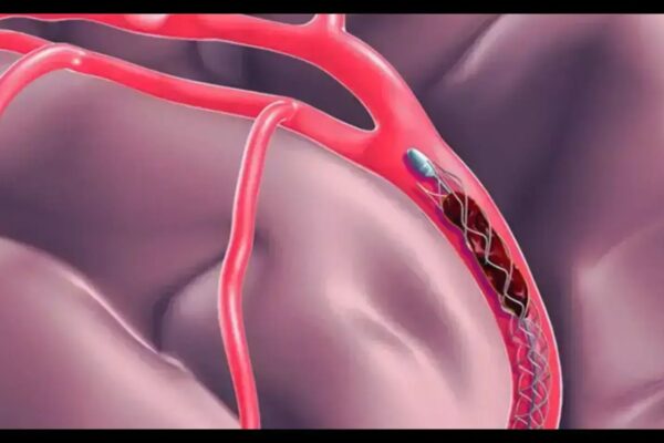 Computer-Assisted Vacuum Thrombectomy Shows Faster Recovery vs Anticoagulation in Acute Intermediate-High Risk Pulmonary Embolism: Study