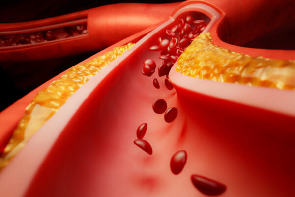 Next-generation blood thinner from Bristol Myers Squibb, J&J fails key trial