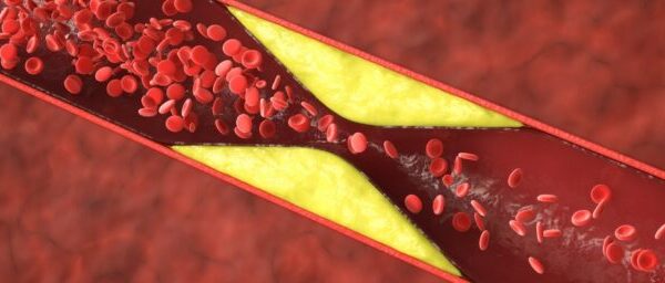 Half of Heart Attacks in Younger Women Aren’t From Clogged Arteries