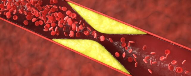 Half of Heart Attacks in Younger Women Aren’t From Clogged Arteries