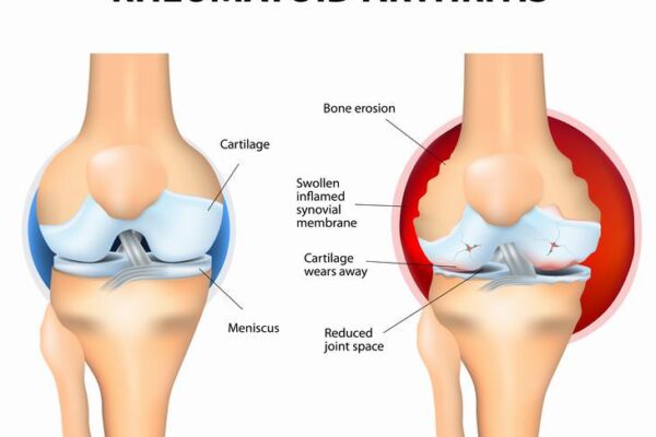 Do You Know the Basic Facts of Rheumatoid Arthritis?