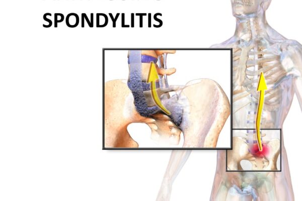 Home Treatments Can Help Manage Ankylosing Spondylitis