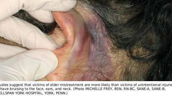 Patterns of Injury in Elder Abuse
