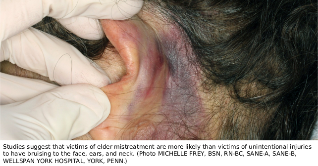 Patterns of Injury in Elder Abuse