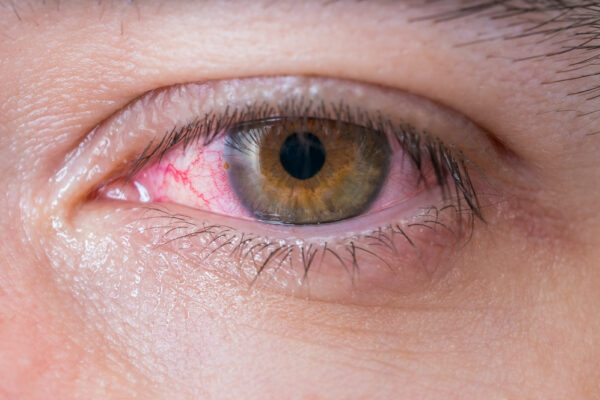 Red Eyes: When is it Harmless, When to Get Checked Out