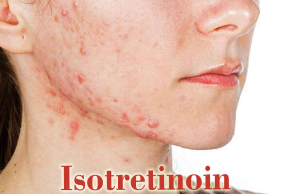 Isotretinoin may temporarily slow growth, but it does not impact the final height of patients: Study