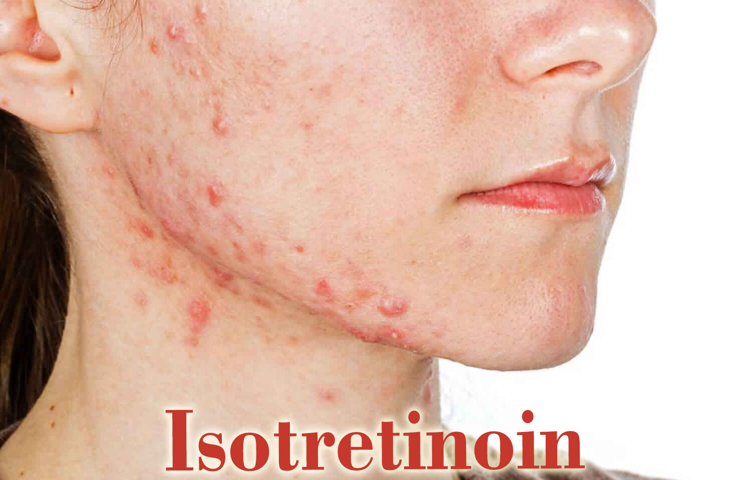 Isotretinoin may temporarily slow growth, but it does not impact the final height of patients: Study