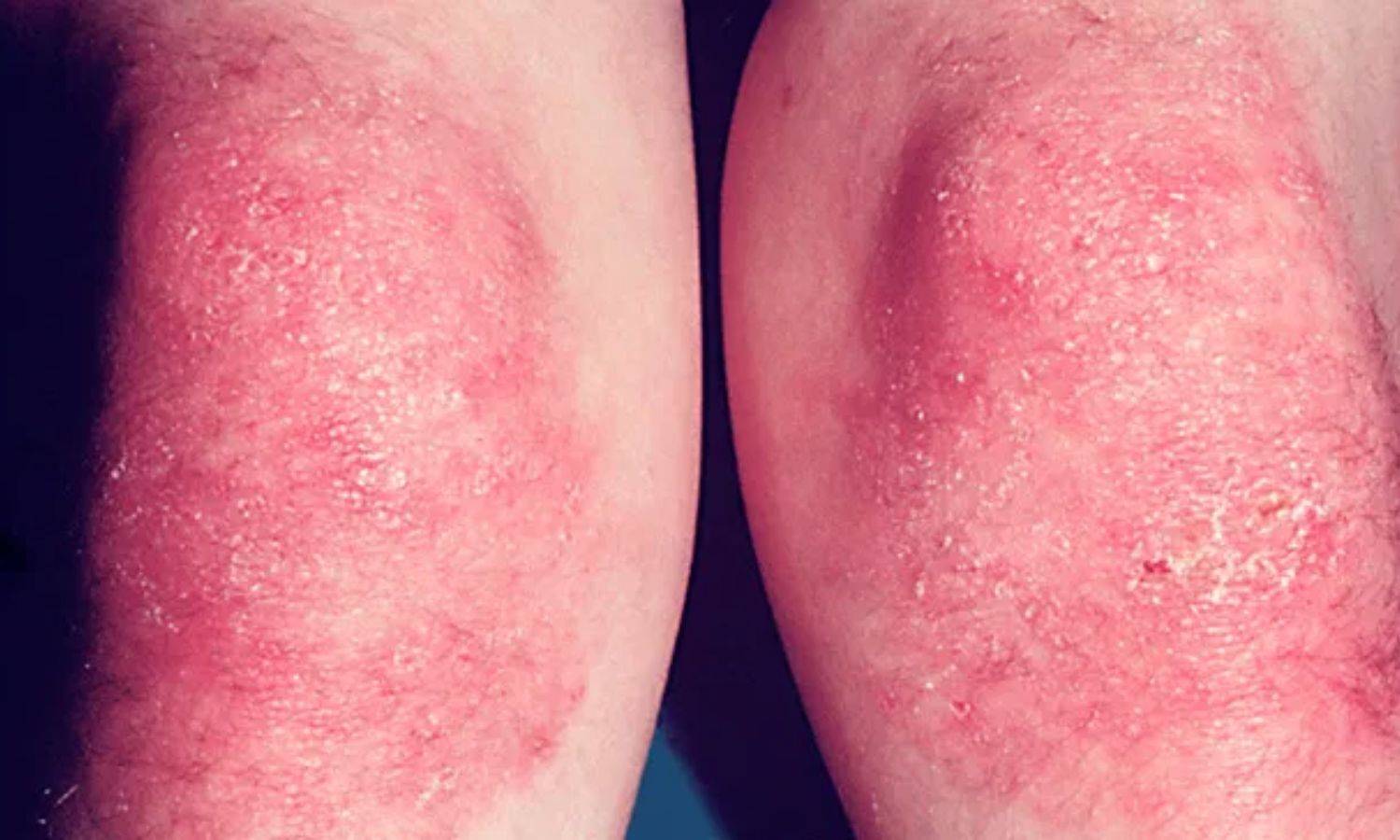 Active Rash, ILD, and Elevated NLR Independently Predict In-Hospital Mortality in Dermatomyositis: JAMA