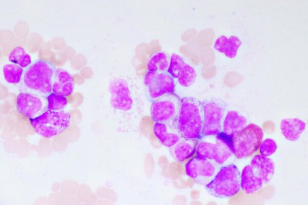 Sylvester Researchers Lead Major Treatment Overhauls for Acute Myeloid Leukemia