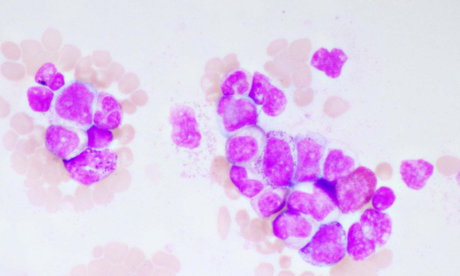 Sylvester Researchers Lead Major Treatment Overhauls for Acute Myeloid Leukemia