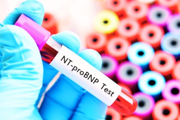 High NT-proBNP Levels Linked to Longer Hospital Stay and Higher Mortality in HF Patients: Study