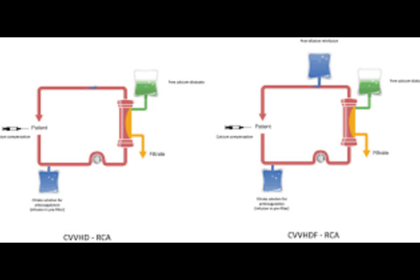 Regional citrate anticoagulation-CRRT with Calcium-Containing Solution Found Safe and Effective: Study