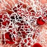 Effectiveness of anti-clotting meds after stent placement varied in people with diabetes: Study