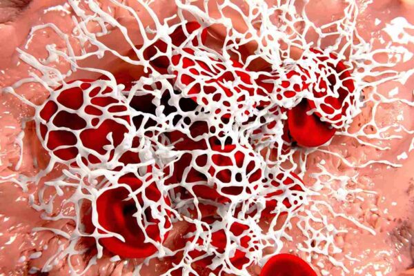 Effectiveness of anti-clotting meds after stent placement varied in people with diabetes: Study