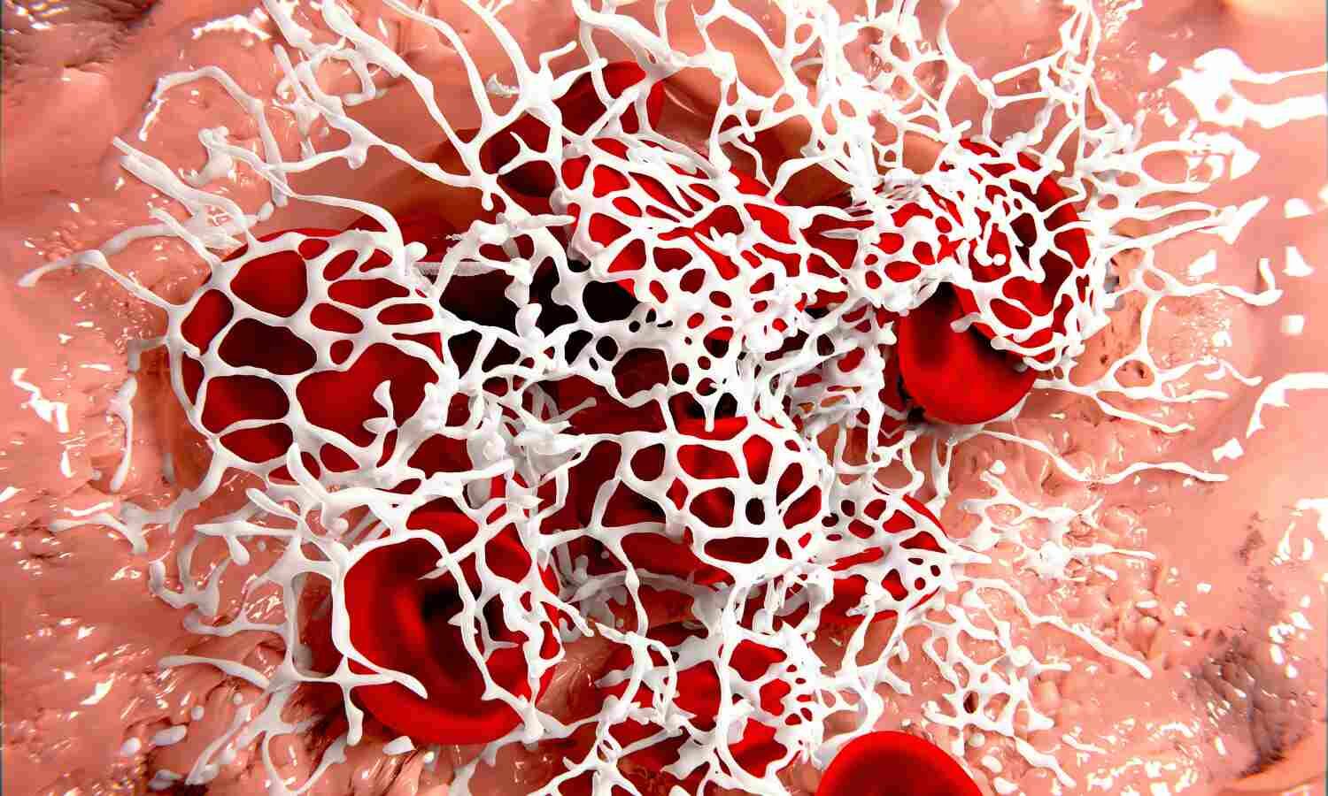 Effectiveness of anti-clotting meds after stent placement varied in people with diabetes: Study