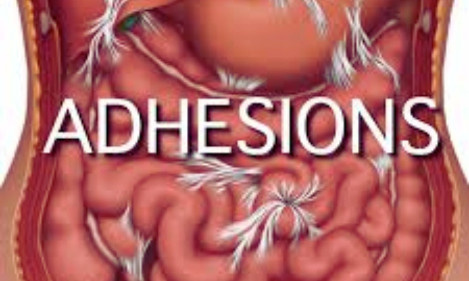 Visceral Fat-to-Muscle Ratio Tied to Inflammatory Ileus After Ileus-Focused Enterolysis: Study