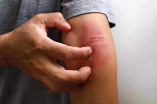 Upadacitinib Shows Rapid, Significant Real-World Benefits in Atopic Dermatitis: Study