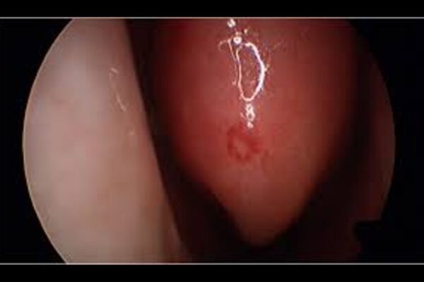 Engasertib Shows Favorable Safety Profile and Reduces Epistaxis in hereditary hemorrhagic telegenctasia: Study