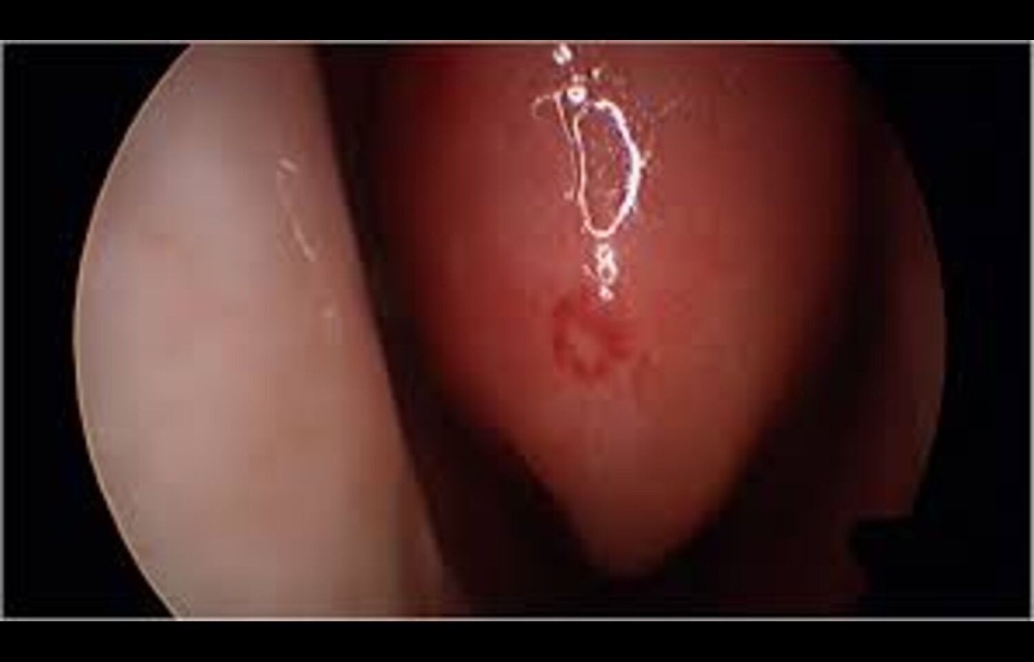 Engasertib Shows Favorable Safety Profile and Reduces Epistaxis in hereditary hemorrhagic telegenctasia: Study