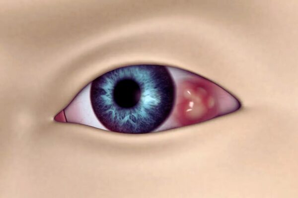 Compounded Imiquimod has Potential Role in Treatment of Ocular Surface Malignancies: JAMA