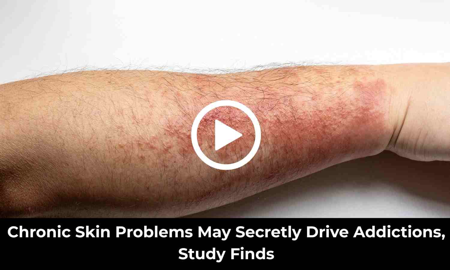 Chronic Skin Problems May Secretly Drive Addictions, Study Finds