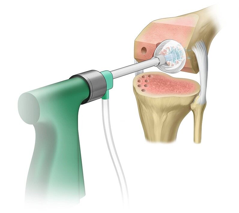 No Added Advantage of High-Pressure Pulsatile Lavage Over Manual Lavage for Cement Penetration in TKR: Study