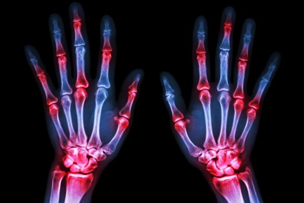 Rheumatoid Arthritis and Its Link to Lung Disease