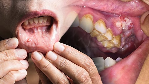 Alcohol, smokeless tobacco driving 62% mouth cancer cases in India’: Study