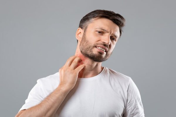 Systemic Lupus Erythematosus with Chronic Spontaneous Urticaria Risk