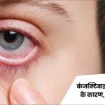 कंजंक्टिवाइटिस (आंख आना) के कारण, लक्षण और उपचार