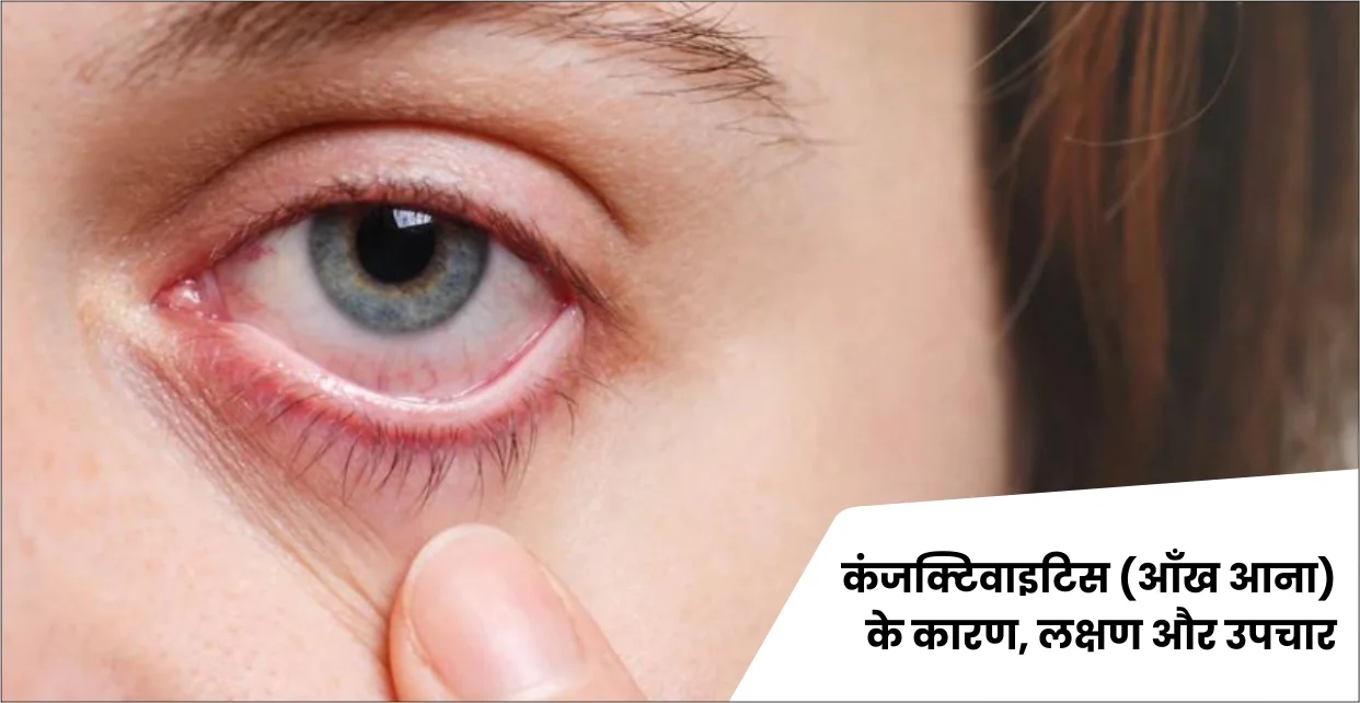 कंजंक्टिवाइटिस (आंख आना) के कारण, लक्षण और उपचार