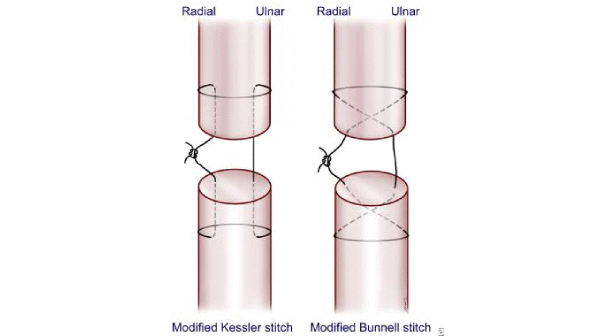Extensor Tendon Repair by Emergency Physicians