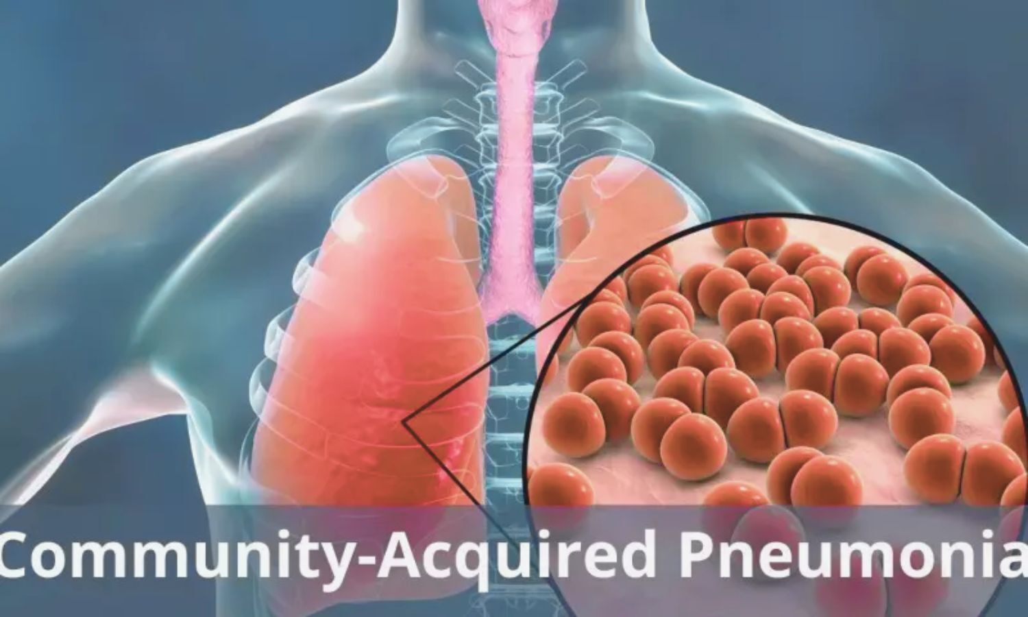 Traditional Chinese Medicine Injections Show Potential Benefit in Older Adults With Community-Acquired Pneumonia