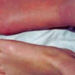 Bisphosphonates Linked to Short-Term Pain Reduction in Complex Regional Pain Syndrome: Study