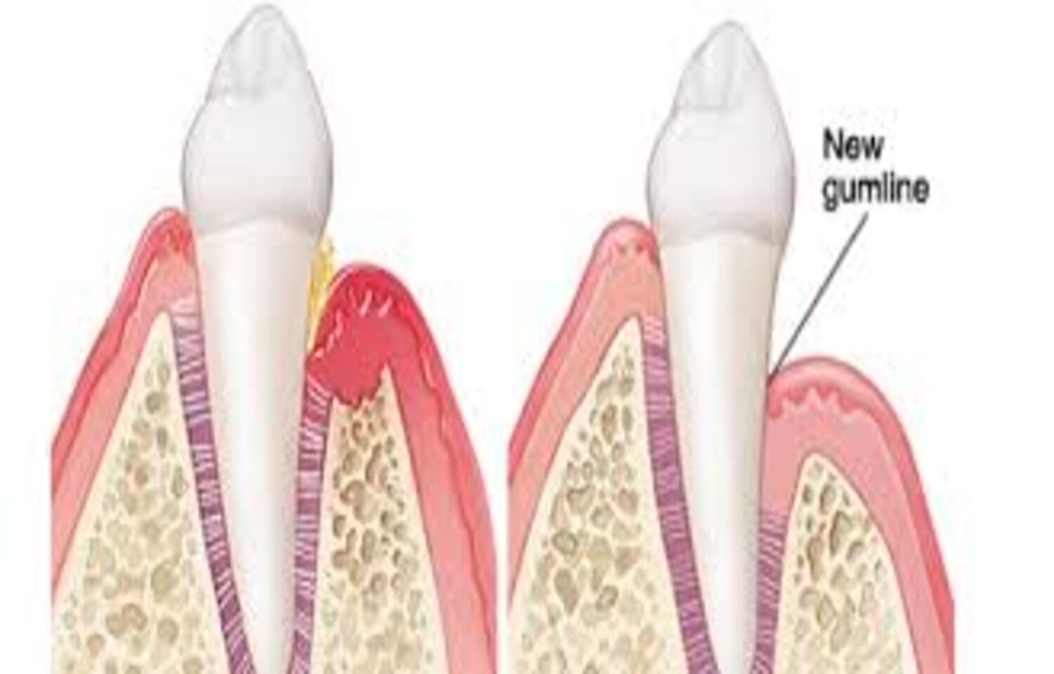 Access flap surgery effective treatment option for Deep Residual Periodontal Pockets, suggests study