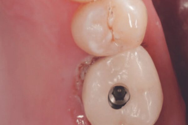 Methacrylate Threadlockers found best for Enhancing Abutment Screw Retention: Study