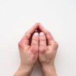 Deucravacitinib Shows Durable Efficacy in Psoriasis Over 2 Years, finds study