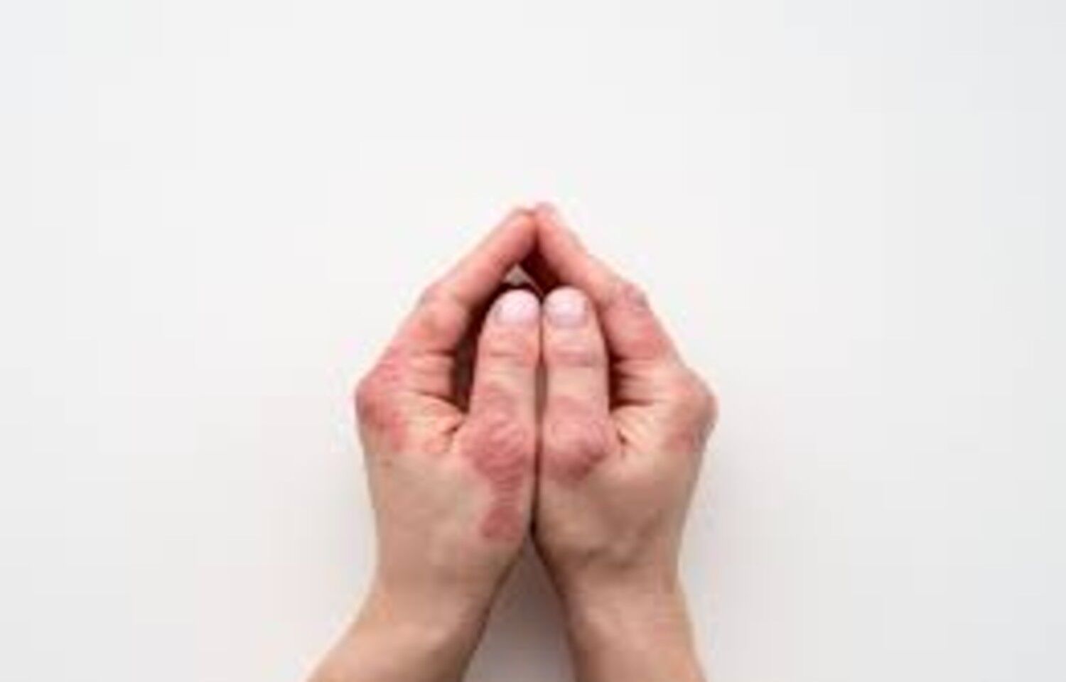 Deucravacitinib Shows Durable Efficacy in Psoriasis Over 2 Years, finds study